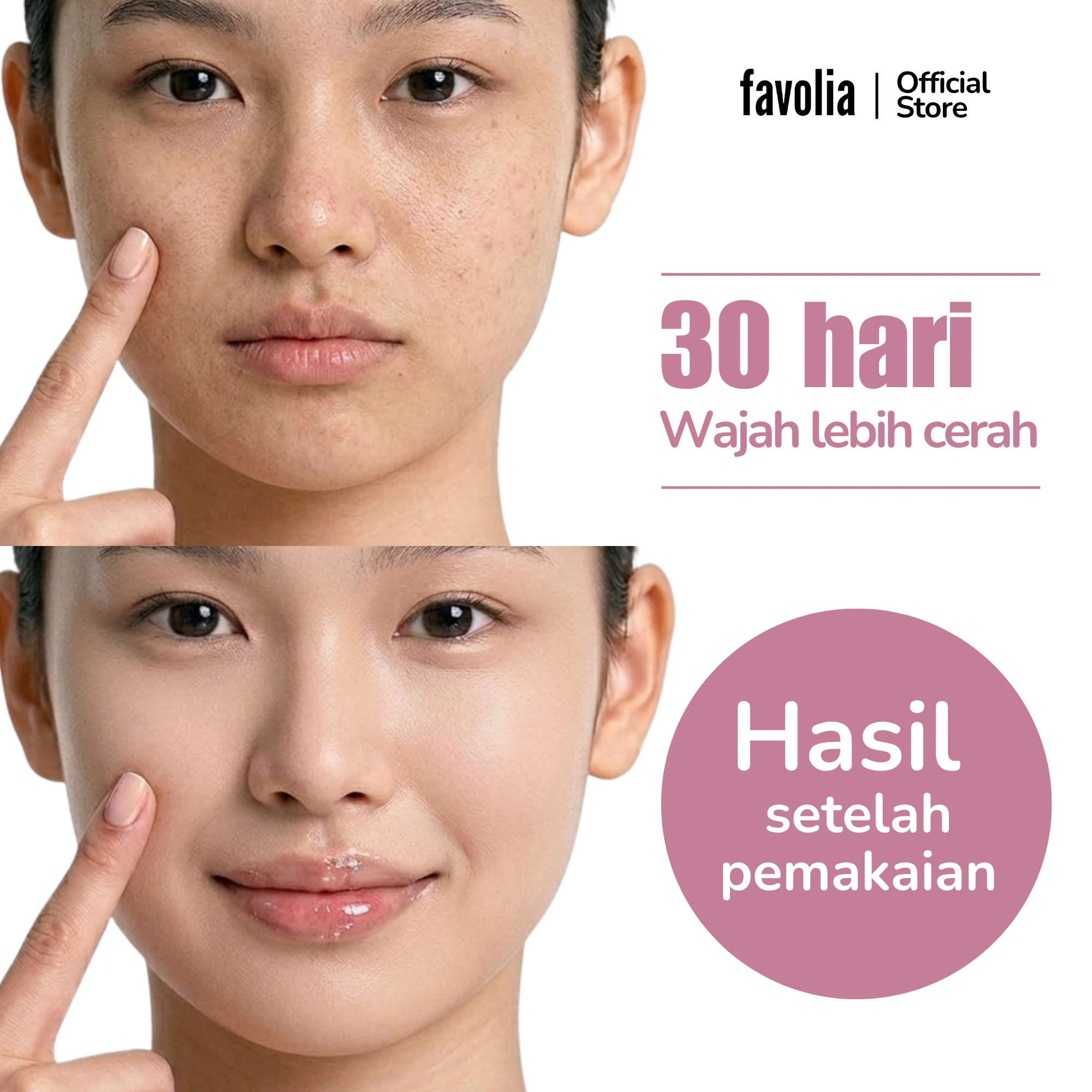 Perbandingan wajah sebelum dan sesudah pemakaian 30 hari, kulit tampak lebih cerah dan bebas noda setelah pemakaian.
